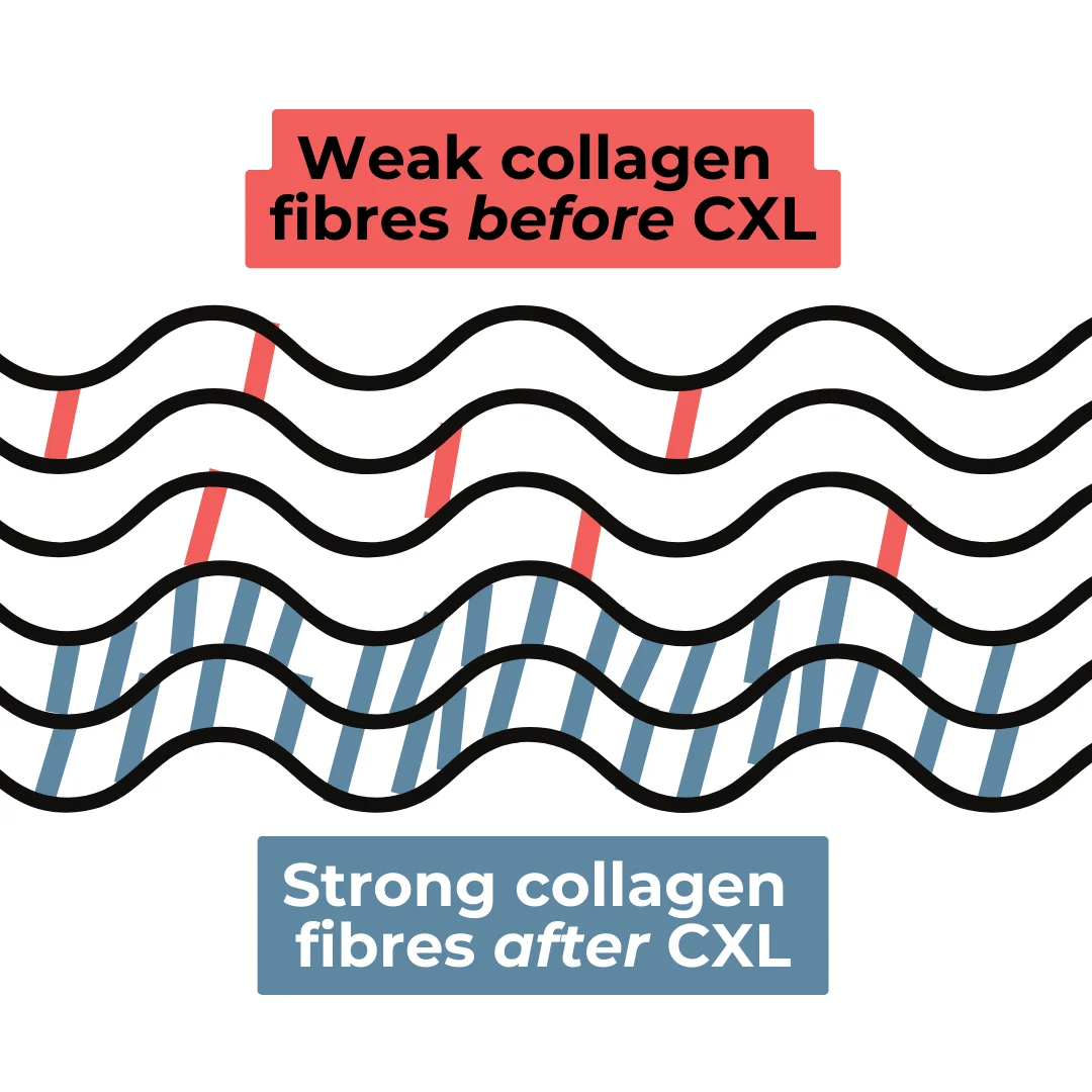 Diagram of corneal collagen cross-linking treatment for keratoconus